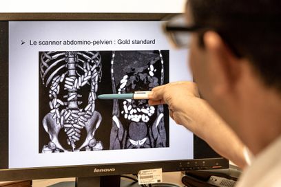 Un médecin de l’unité médico-judiciaire de l’hôpital de Cayenne (Guyane), regarde une radiographie abdominale montrant des ovules de cocaïne dans les intestins d’une mule, en 2022.